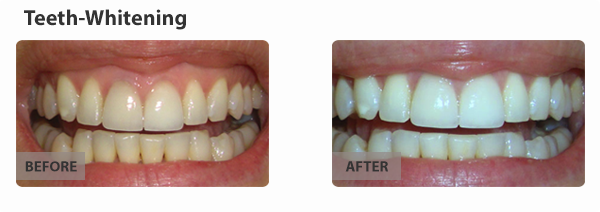 teeth-whitening-img1