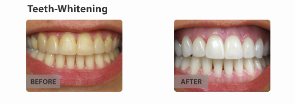 teeth-whitening-img2