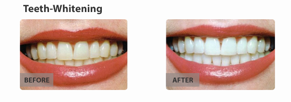 teeth-whitening-img3